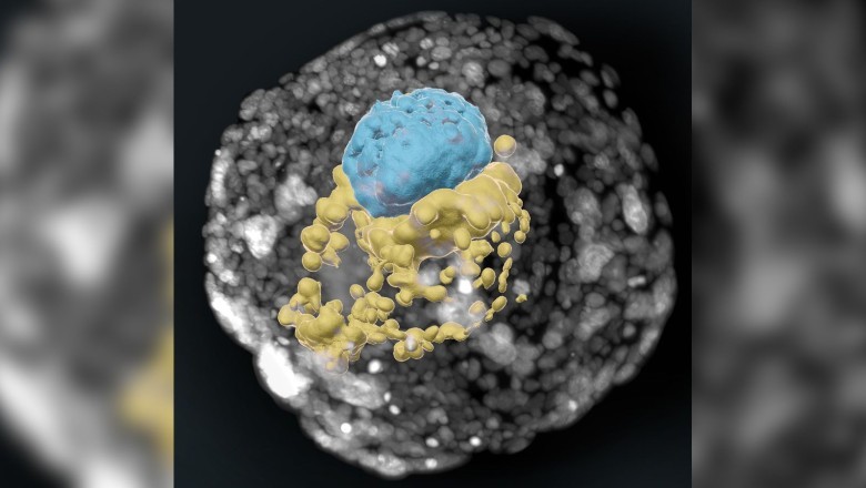FDA considers first CRISPR gene editing treatment that may cure sickle cell