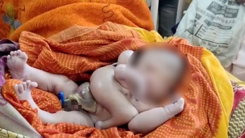 Woman gives birth to baby with four arms and four legs in Sindh