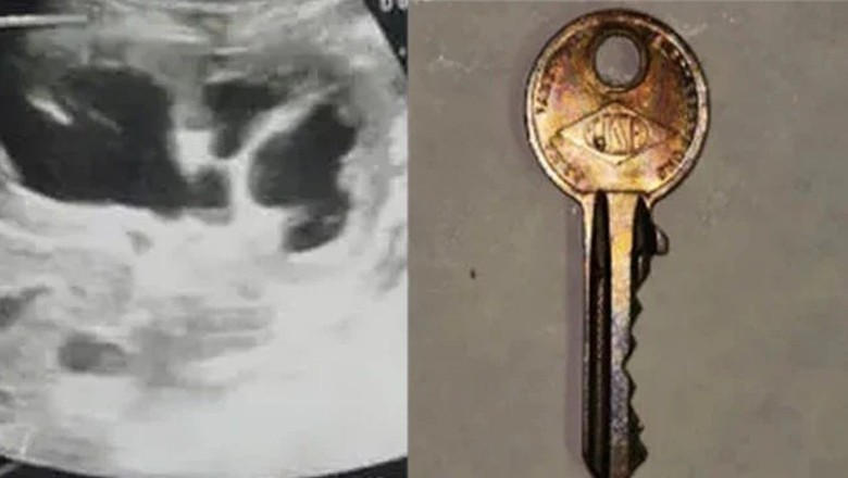 Doctors remove key from 5-year-old's stomach in Lahore