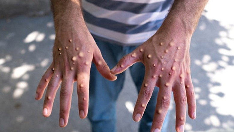 Missing monkeypox patient found in Mardan