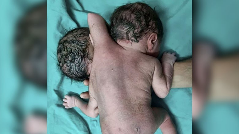 Baby with 'two heads' born in Pakistan's Faisalabad