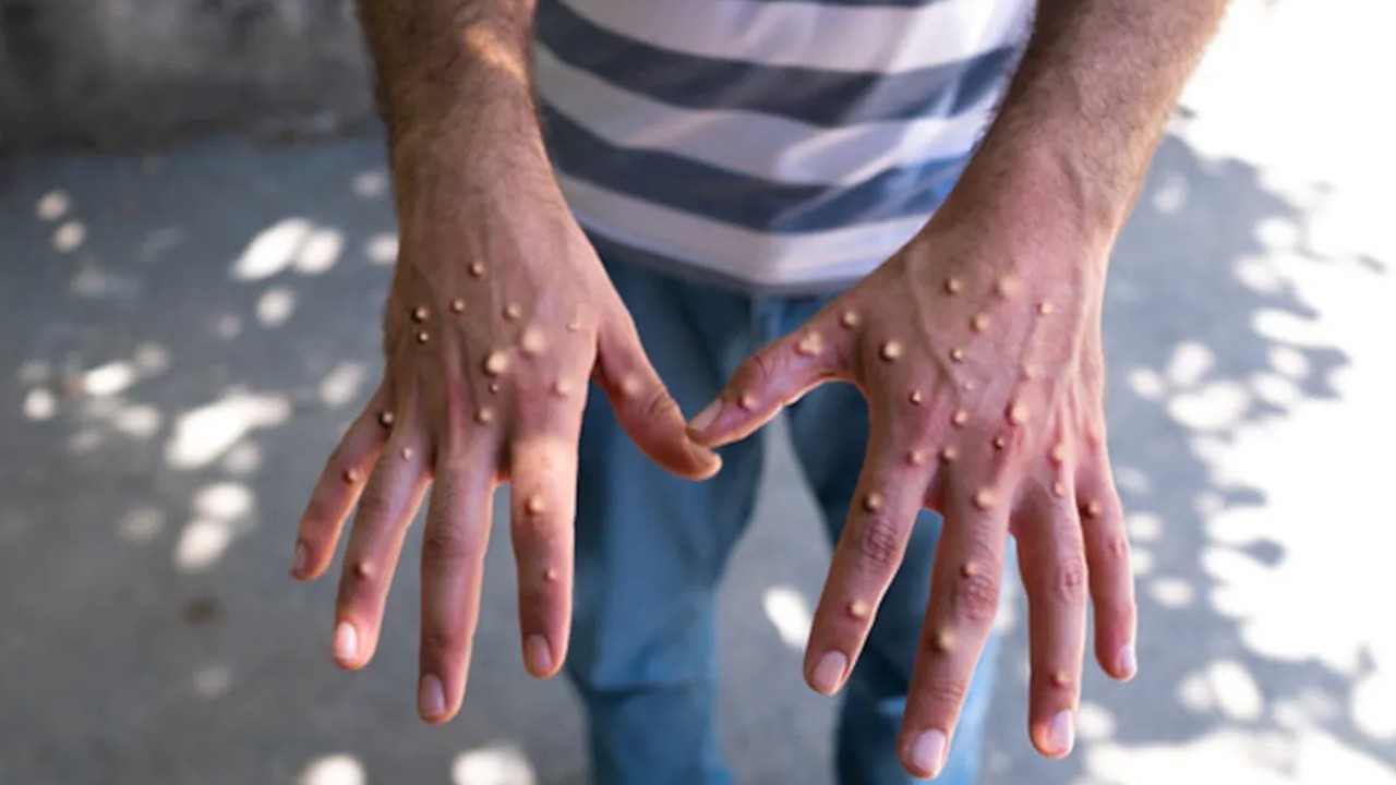 Pakistan confirms first monkeypox case of 2025