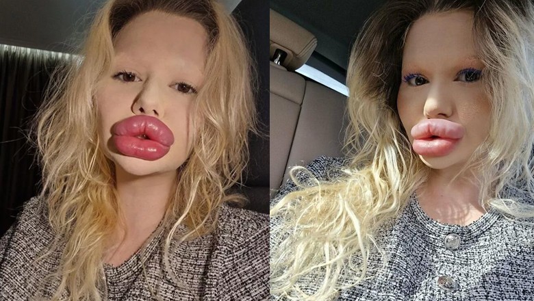 Woman claiming to have world's biggest lips seeks more fillers