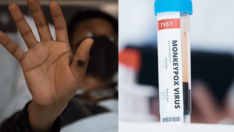 Monkeypox detected in Saudi Arabia returnee at Karachi airport