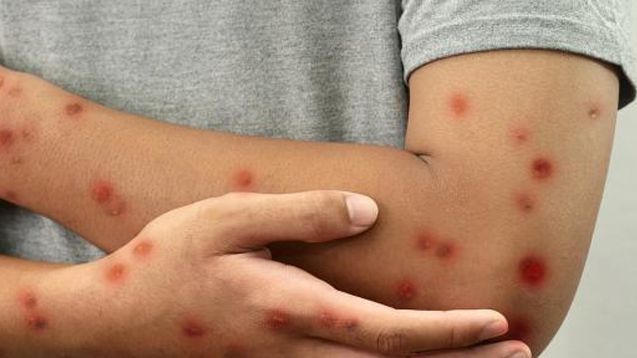 Lahore registers three new monkeypox cases