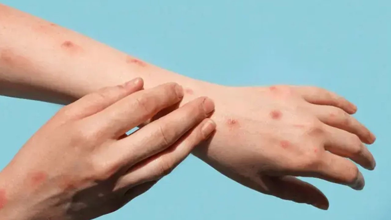 Karachi reports another Mpox case, city’s tally rises to 10