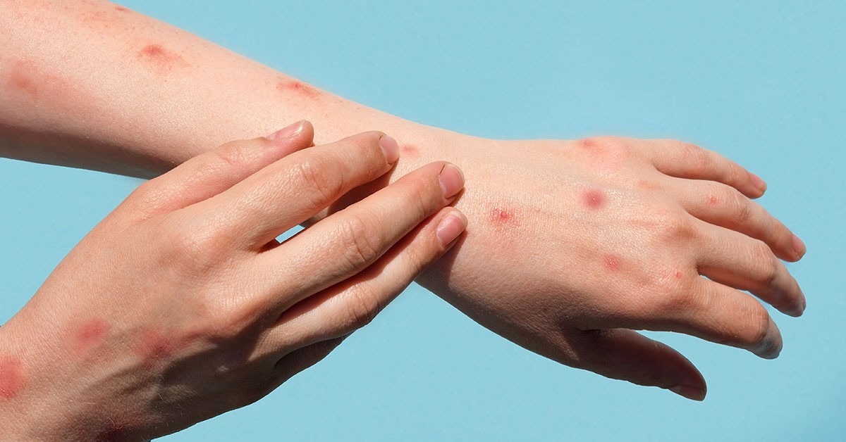Mpox: Symptoms, transmission and ways to stay protected