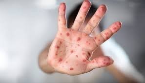 کراچی میں بھی خسرہ پھیلنے لگی