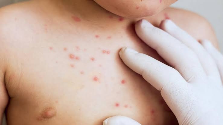 اندرون سندھ میں خسرہ سے 19 بچے جاں بحق