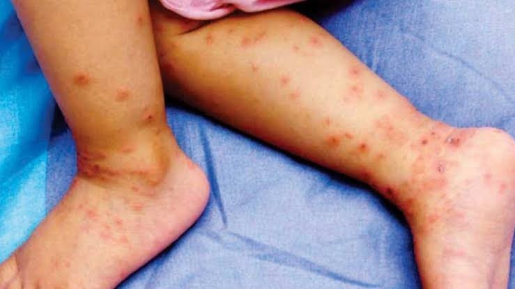 خسرہ کی وبا پھیلی گئی، ایک ہفتے میں پانچ بچے جاں بحق