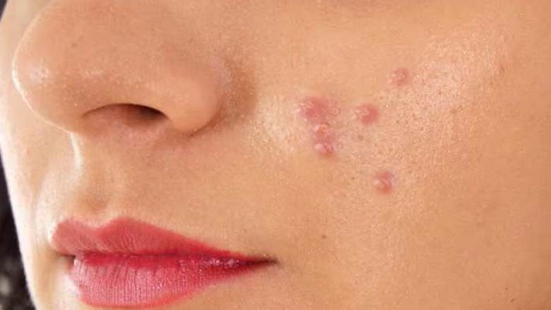 برطانیہ: سورج کی تیز تپش سے جِلدی کینسر پھیلنے کا انکشاف