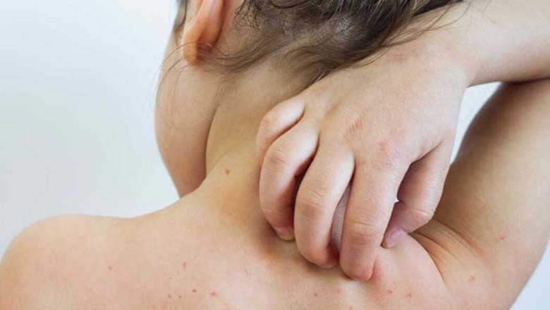 ملک میں خسرہ اور نیگلیریا پھیلنے کا خدشہ، ایڈوائزری جاری