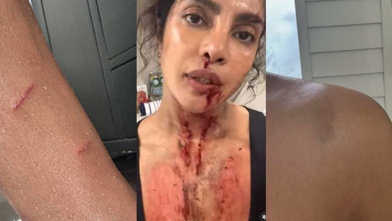 پریانکا چوپڑا انگلش ایکشن فلم کے دوران زخمی، چہرہ لہو لہان، جسم پر زخم کے نشانات
