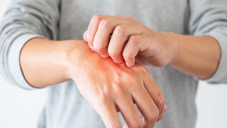 کراچی میں گرمی کی شدت کے سبب جِلدی امراض میں اضافہ