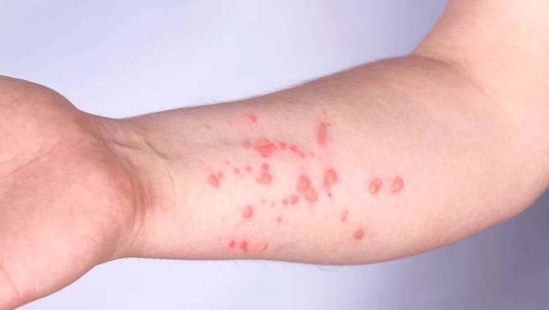 پاکستان میں منکی پاکس کا مشتبہ کیس رپورٹ