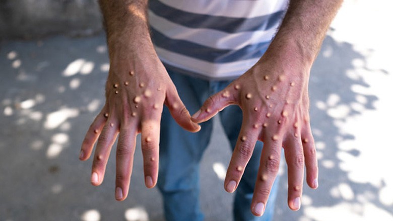 پاکستان میں منکی پاکس کے تین کیسز رپورٹ، تینوں مشتبہ افراد کا تعلق ایک صوبے سے