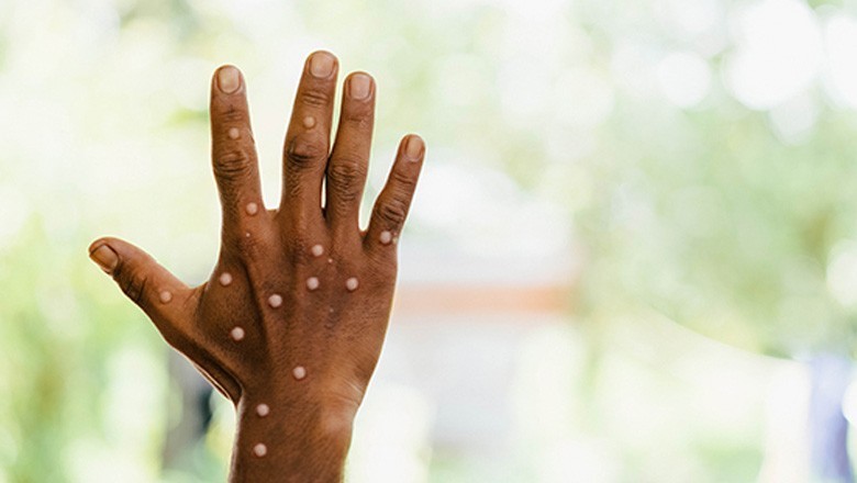 ’گھبرانا نہیں ہے‘ : عالمی ادارہ صحت کا منکی پاکس سے خوفزدہ شہریوں کیلیے پیغام