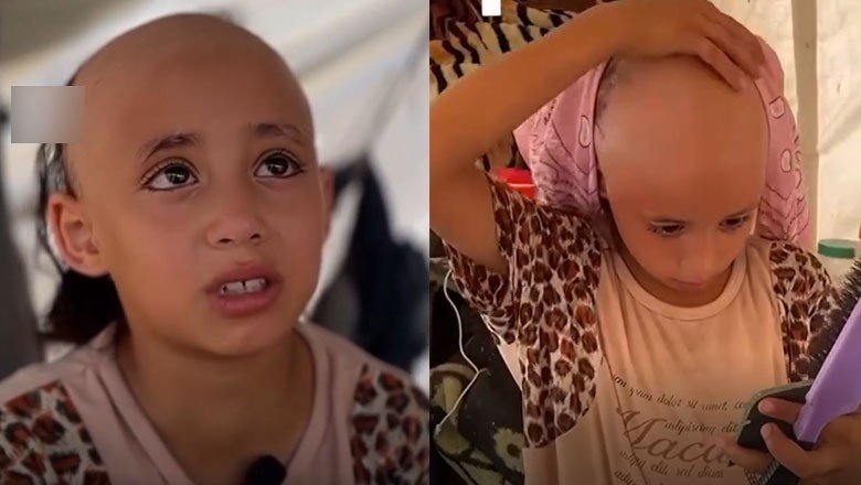غزہ میں اسرائیلی بربریت کا شکار دماغی تناؤ سے مکمل گنج پن کا شکار