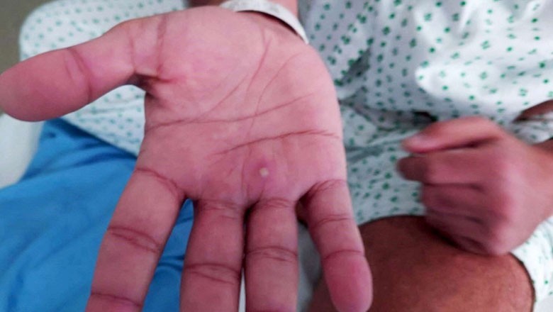 کراچی ایئرپورٹ آنے والے مسافر کو منکی پاکس کی تشخیص