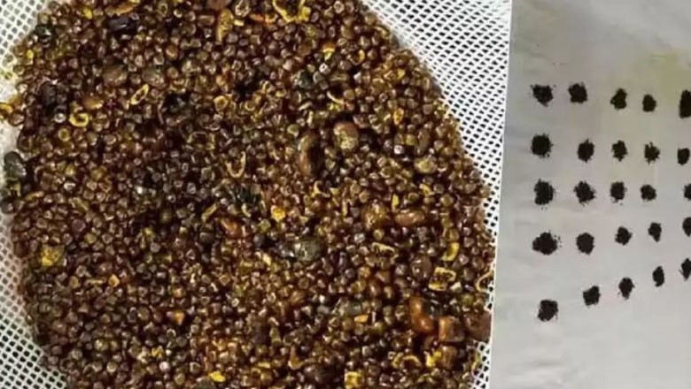 70 سالہ بزرگ کے پتے سے 6 ہزار پتھر برآمد