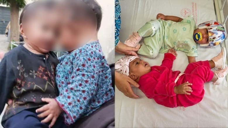 ترک ڈاکٹروں نے 11 ماہ کی جڑواں بچیوں کو کامیابی سے الگ کر دیا
