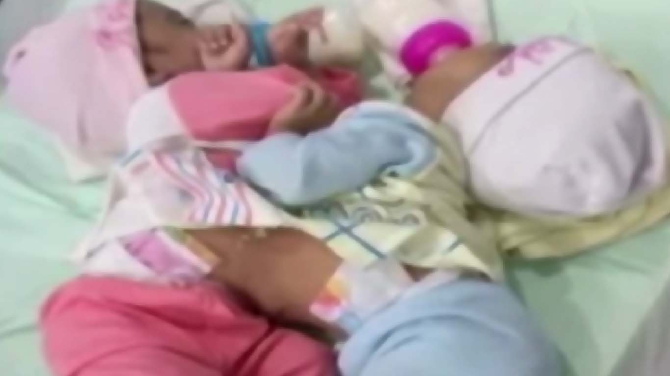 کراچی: دھڑ سے جڑی 2 نومولود بچیوں کی کامیاب سرجری