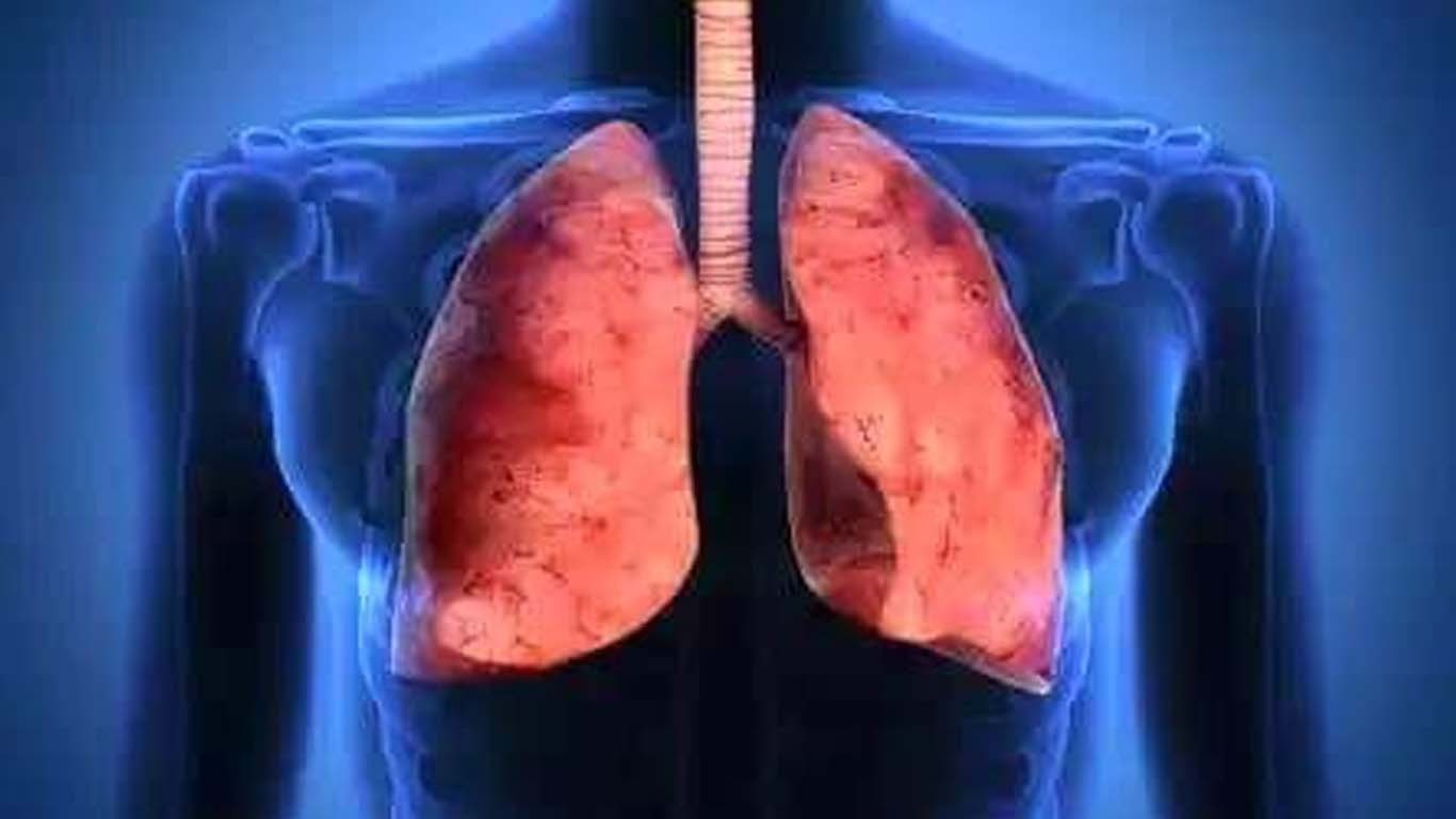 ڈبلیوں ایچ ا و نے ٹی بی کی تشخیص کے لئے نیا ٹیسٹ متعارف کرادیا