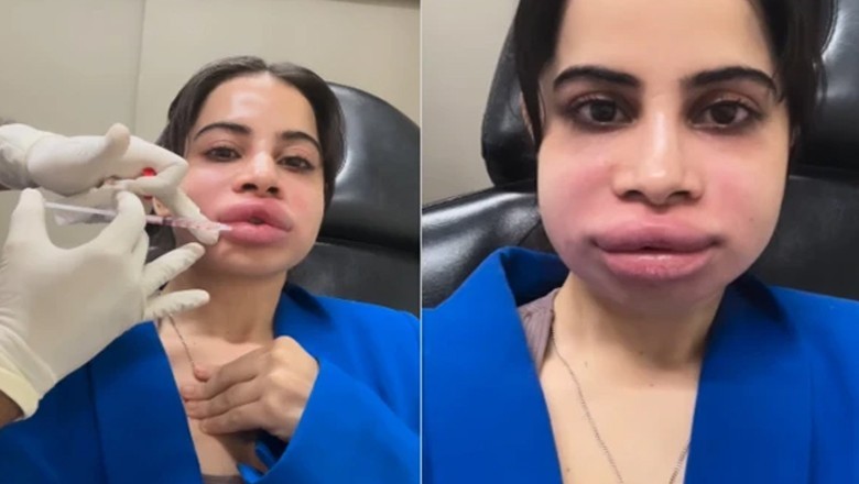 لپ فلر کی وجہ سے عرفی جاوید کا چہرہ بگڑ گیا، اداکارہ نے انتہائی قدم اٹھا لیا، ویڈیو دیکھیں