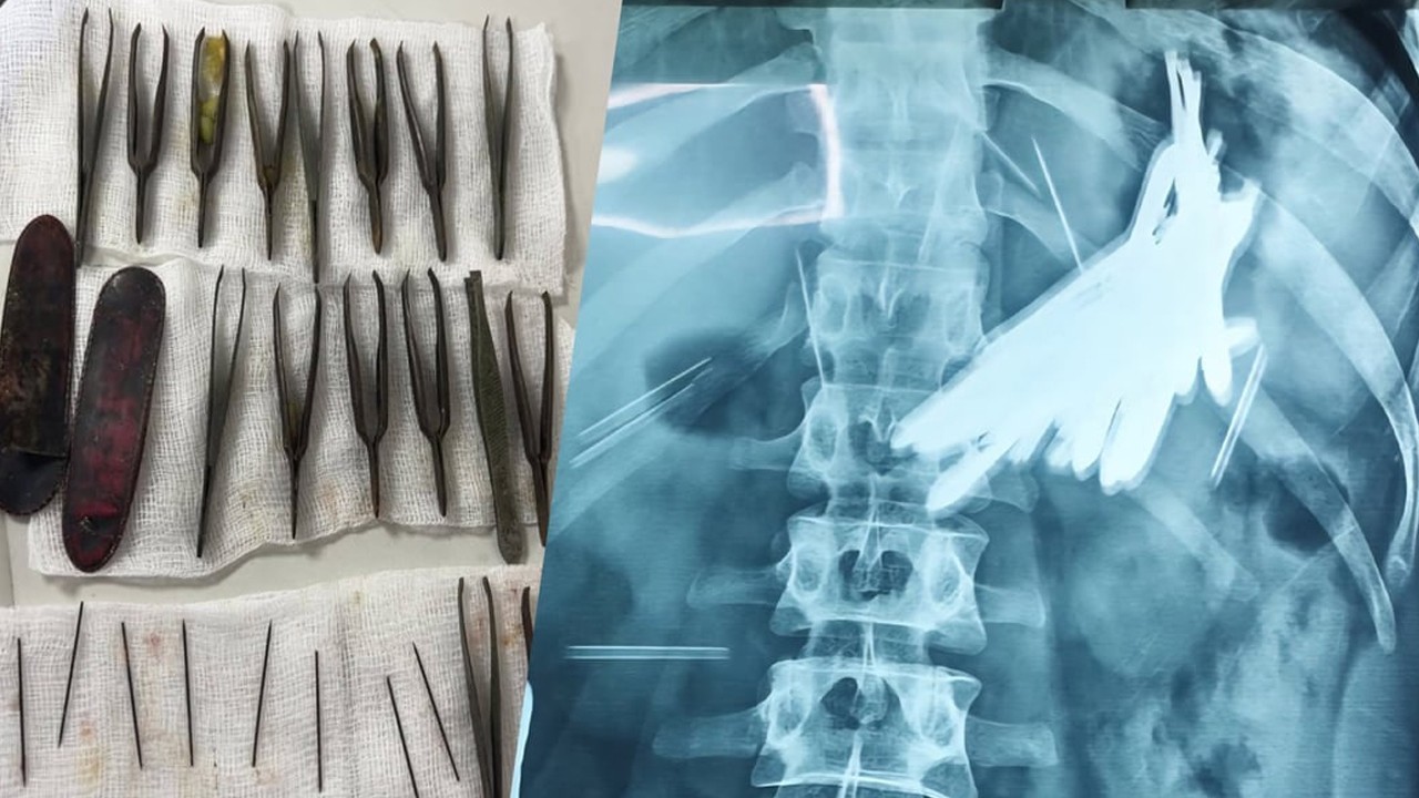 شہری کے پیٹ سے 2 درجن کے زائد دھاتی اشیا  برآمد