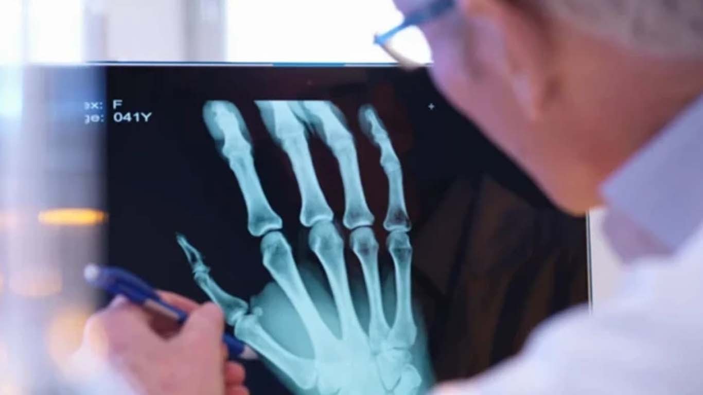 چین کی نئی ایجاد، 3 منٹ میں فریکچر کا علاج ممکن