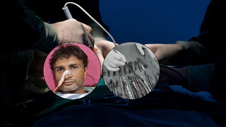 بھارت میں 35 سالہ شخص کے پیٹ سے 29 اسٹیل کے چمچے، 19 ٹوتھ برش، 2 پین برآمد