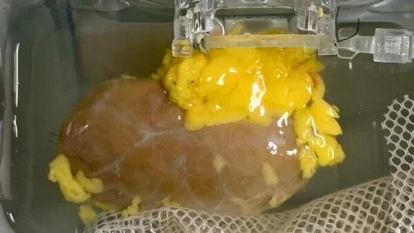 طب کی دنیا میں بڑی کامیابی، ماہرین نے مصنوعی گردہ تیار کرلیا جو کسی کو بھی باآسانی لگایا جاسکتا ہے