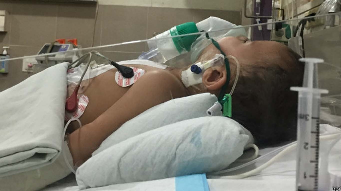 چکن پاکس نے تین نومولود بچوں کی جان لے لی