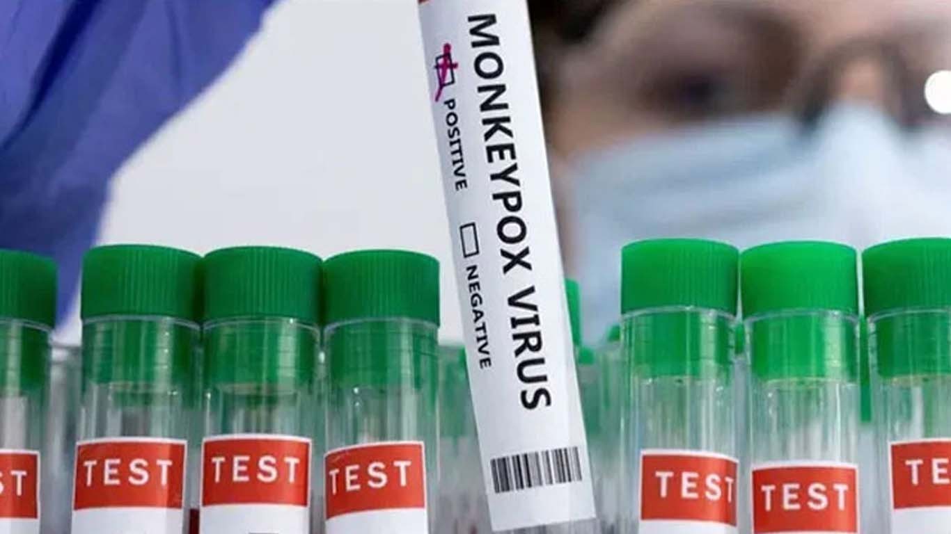 کراچی: منکی پاکس کا ایک اور کیس رپورٹ