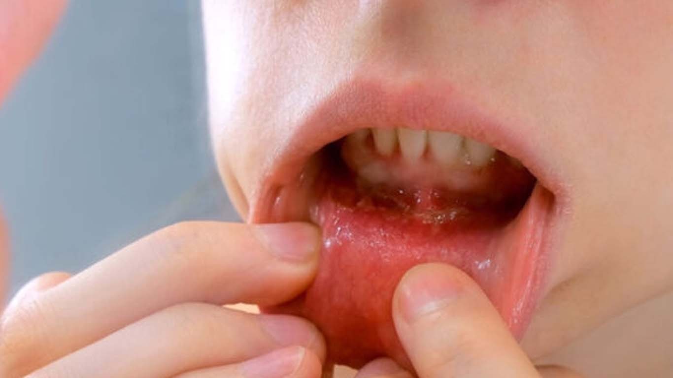 ایشیا میں منہ کے کینسر کی شرح پاکستانی مردوں میں سب سے زیادہ ہونے کا انکشاف