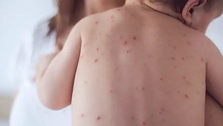 سندھ میں رواں سال کے 8 ماہ میں خسرہ، خناق سے 88 بچوں کی اموات